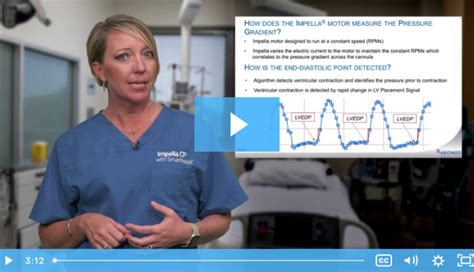 lv pressure waveform|SmartAssist®: Deriving the LV Waveform and Measuring LVEDP.